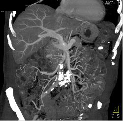 Sclerosing Mesenteritis - CTisus CT Scan