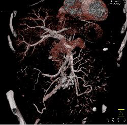 Sclerosing Mesenteritis - CTisus CT Scan