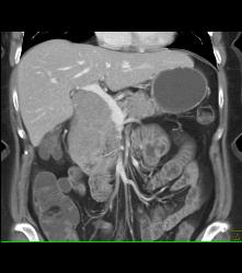 Lymphoma Simulates A Pancreatic Mass. See Mesenteric Nodes - CTisus CT Scan