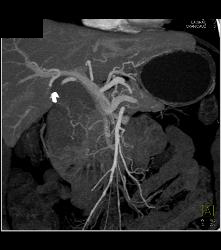 Lymphoma Simulates A Pancreatic Mass. See Mesenteric Nodes - CTisus CT Scan