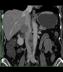 Lymphoma Simulates A Pancreatic Mass. See Mesenteric Nodes - CTisus CT Scan