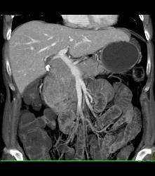 Lymphoma Simulates A Pancreatic Mass. See Mesenteric Nodes - CTisus CT Scan