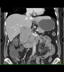 Lymphoma Simulates A Pancreatic Mass. See Mesenteric Nodes - CTisus CT Scan