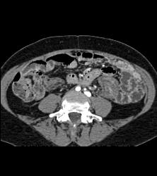 Implants on Small Bowel C/w Carcinomatosis - CTisus CT Scan