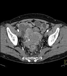 Implants on Small Bowel C/w Carcinomatosis - CTisus CT Scan