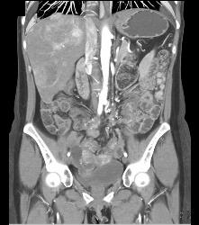 Implants on Small Bowel C/w Carcinomatosis - CTisus CT Scan