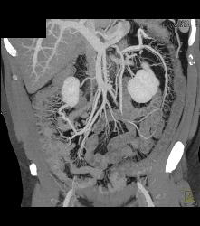 Inflammatory Bowel Disease (IBD) With Nice Vasa Recta - CTisus CT Scan