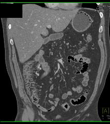 Inflammatory Bowel Disease (IBD) With Nice Vasa Recta - CTisus CT Scan