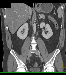 Inflammatory Bowel Disease (IBD) With Nice Vasa Recta - CTisus CT Scan