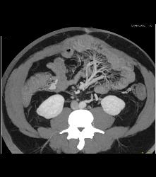 Inflammatory Bowel Disease (IBD) With Nice Vasa Recta - CTisus CT Scan