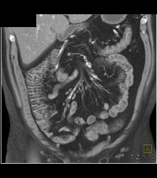 Inflammatory Bowel Disease (IBD) With Nice Vasa Recta - CTisus CT Scan