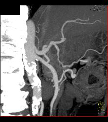 Mesenteric Arcade - CTisus CT Scan