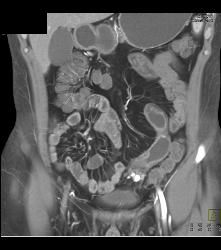 Crohn's Disease - CTisus CT Scan