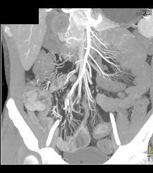 Crohn's Disease - CTisus CT Scan