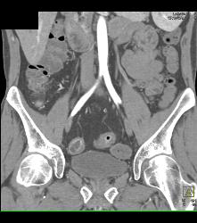 Crohn's Disease - CTisus CT Scan