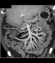 Crohn's Disease - CTisus CT Scan