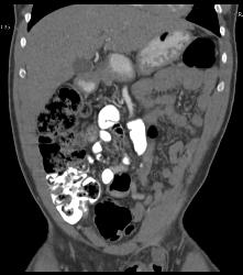 Hernia of Small Bowel Into Inguinal Ring and Then Scrotum - CTisus CT Scan