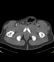 Hernia of Small Bowel Into Inguinal Ring and Then Scrotum - CTisus CT Scan