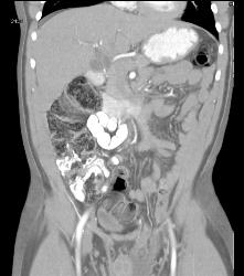 Hernia of Small Bowel Into Inguinal Ring and Then Scrotum - CTisus CT Scan