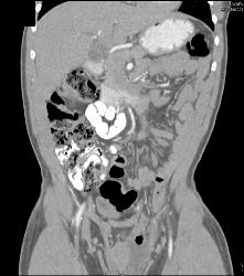 Hernia of Small Bowel Into Inguinal Ring and Then Scrotum - CTisus CT Scan