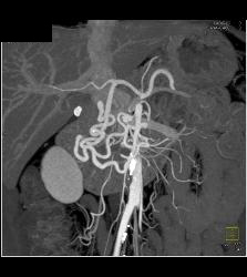 Median Arcuate Ligament Syndrome With Stenosis Celiac Artery - CTisus CT Scan