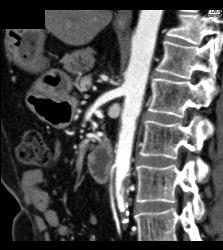 Median Arcuate Ligament Syndrome With Stenosis Celiac Artery - CTisus CT Scan