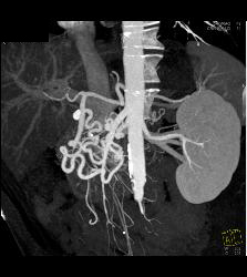 Median Arcuate Ligament Syndrome With Stenosis Celiac Artery - CTisus CT Scan