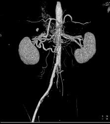 Median Arcuate Ligament Syndrome With Stenosis Celiac Artery - CTisus CT Scan