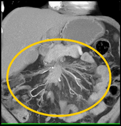 Carcinoid Tumor - CTisus CT Scan