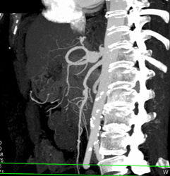 Celiac Artery Aneurysm - CTisus CT Scan