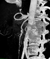 Celiac Artery Aneurysm - CTisus CT Scan