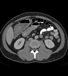 Crohn's With Stenosis and Stricture and Small Bowel Obstruction (SBO) - CTisus CT Scan