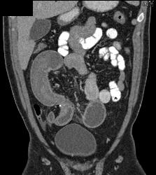 Crohn's With Stenosis and Stricture and Small Bowel Obstruction (SBO) - CTisus CT Scan