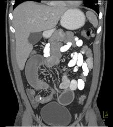 Crohn's With Stenosis and Stricture and Small Bowel Obstruction (SBO) - CTisus CT Scan