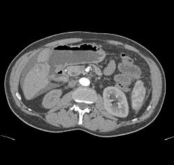 Carcinomatosis - CTisus CT Scan