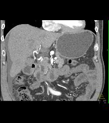 Carcinomatosis - CTisus CT Scan