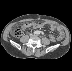 Carcinomatosis - CTisus CT Scan