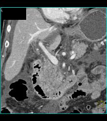 Duodenum Invaded By Pancreatic Cancer - CTisus CT Scan