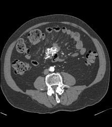 Sclerosing Mesenteritis - CTisus CT Scan