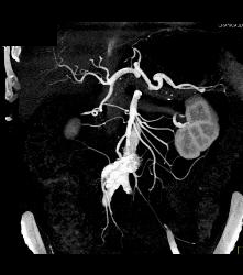 Sclerosing Mesenteritis - CTisus CT Scan