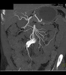 Sclerosing Mesenteritis - CTisus CT Scan