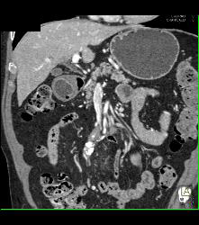 Sclerosing Mesenteritis - CTisus CT Scan