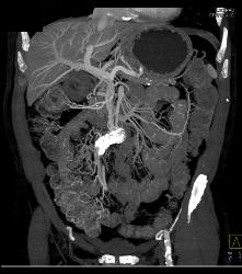 Sclerosing Mesenteritis - CTisus CT Scan