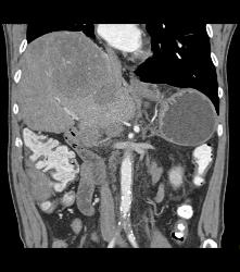 Metastatic Melanoma to Bowel in RLQ - CTisus CT Scan