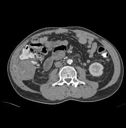 Metastatic Melanoma to Bowel in RLQ - CTisus CT Scan