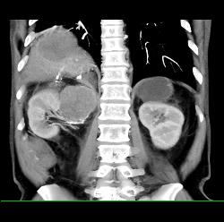 Metastatic Melanoma to Bowel in RLQ - CTisus CT Scan