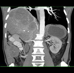 Metastatic Melanoma to Bowel in RLQ - CTisus CT Scan