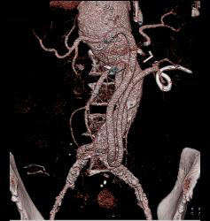 Reimplanted Mesenteric Vessels S/p Aortic Aneurysm Repair - CTisus CT Scan