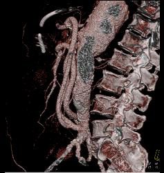 Reimplanted Mesenteric Vessels S/p Aortic Aneurysm Repair - CTisus CT Scan