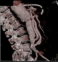 Reimplanted Mesenteric Vessels S/p Aortic Aneurysm Repair - CTisus CT Scan